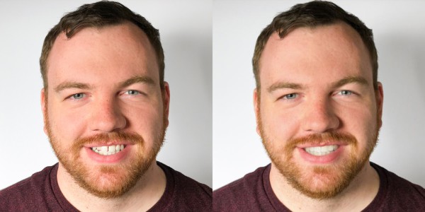 SmileView Before After Brian