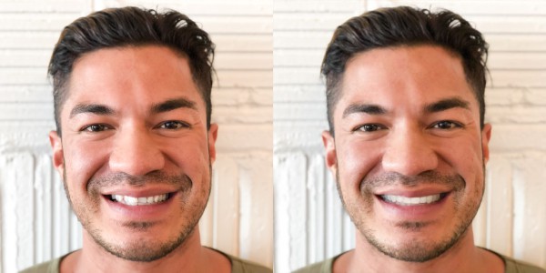 SmileView Before After Shane