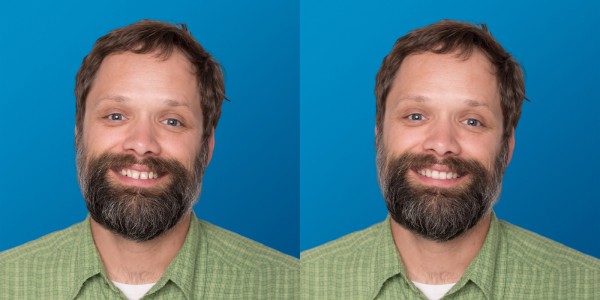SmileView Before After Dan