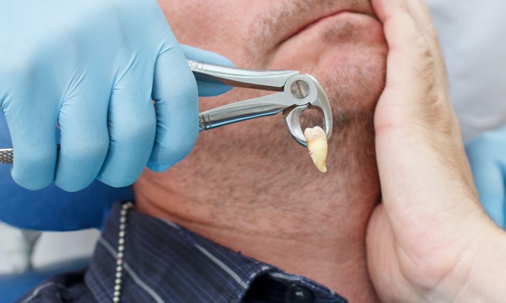 Retainer after wisdom teeth removal