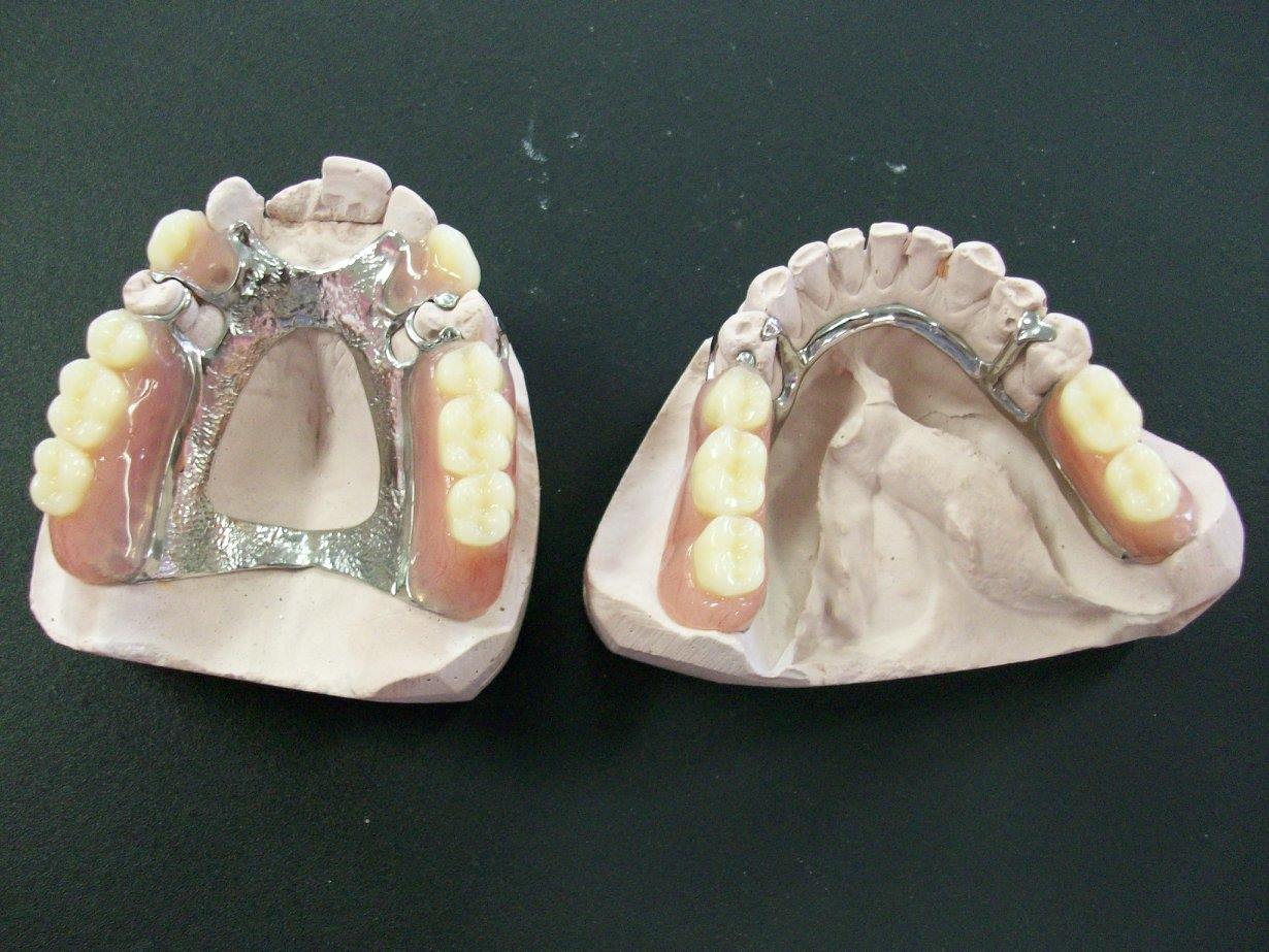 Partial cast dentures