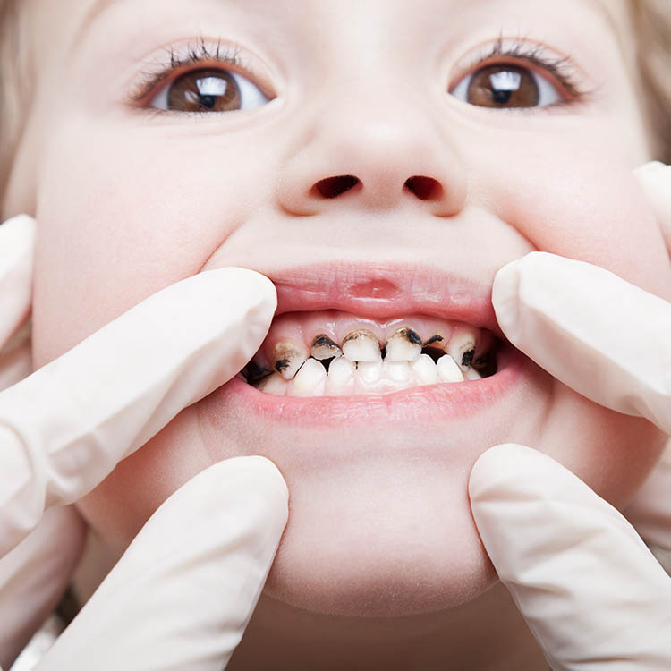 Tooth decay illustration