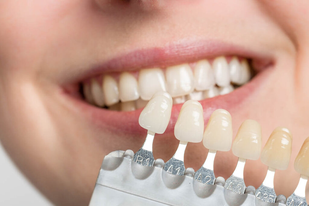 Dentist holding a shade guide against a patient's teeth to choose a natural shade