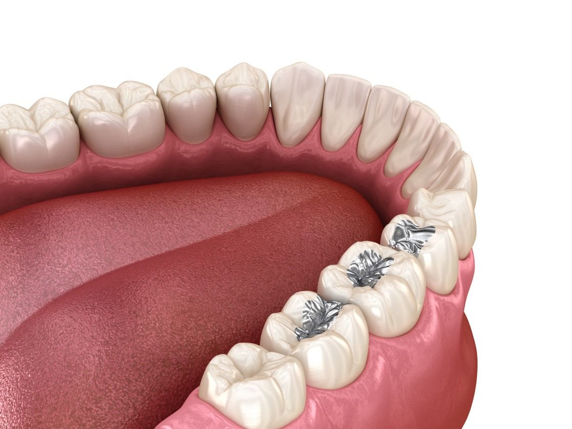 Dental sealants