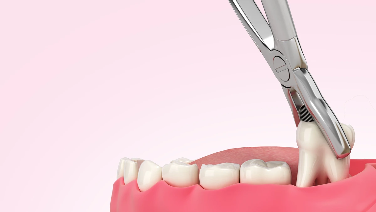 Dental forceps extracting a tooth from a model
