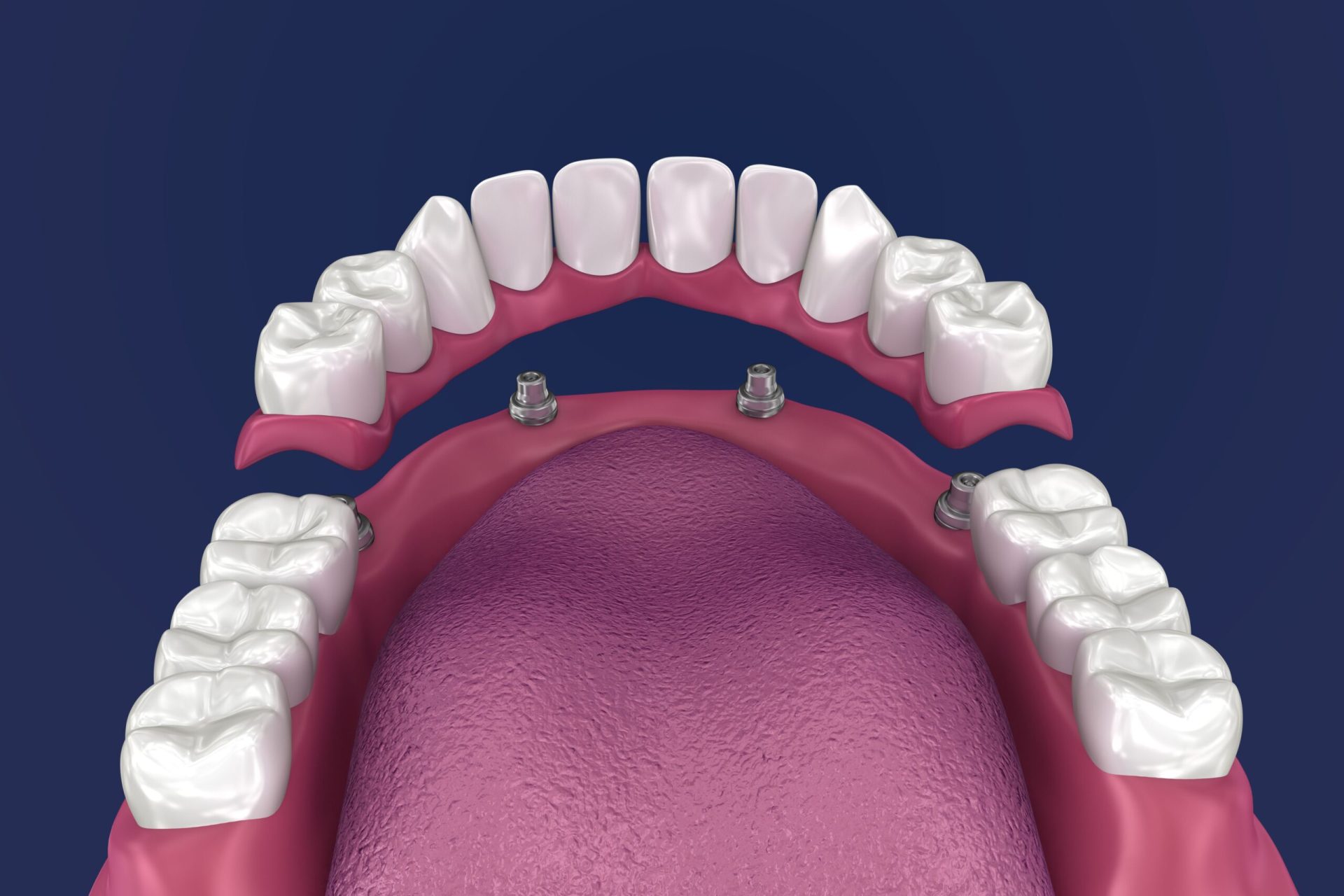 Complete and partial dentures