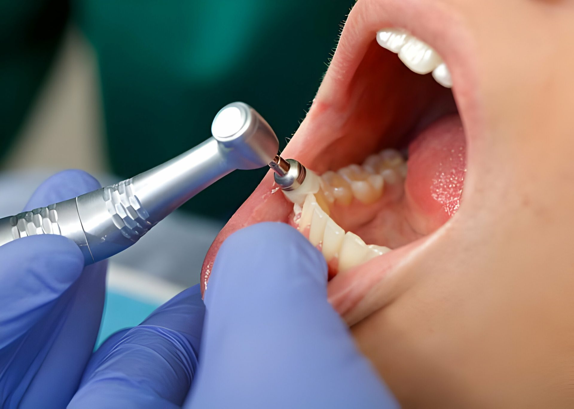 Professional teeth cleaning