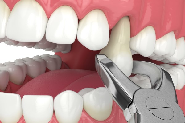 Tooth extraction procedure