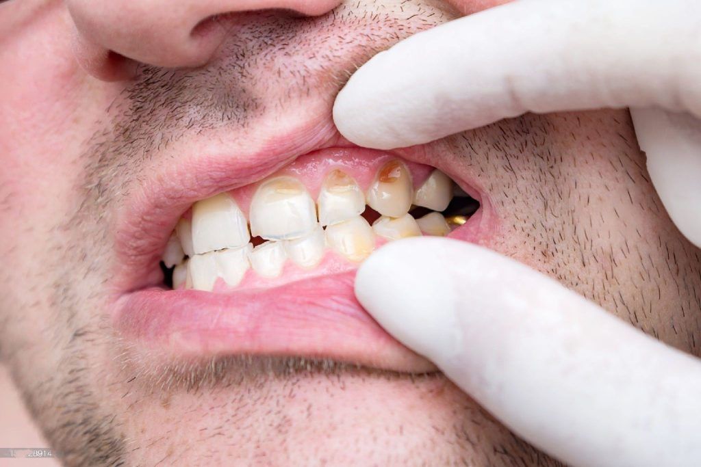 Stages of tooth decay
