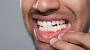 Gum Disease