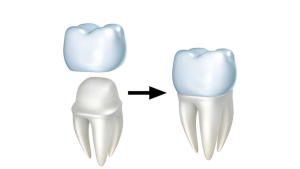 Dental Crown