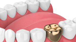Dental Crowns