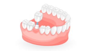Dental Crown