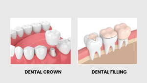 Dental Crown Vs Filling