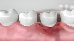 Gum Disease