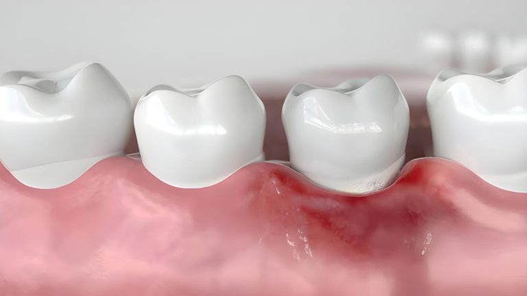 Gum Disease