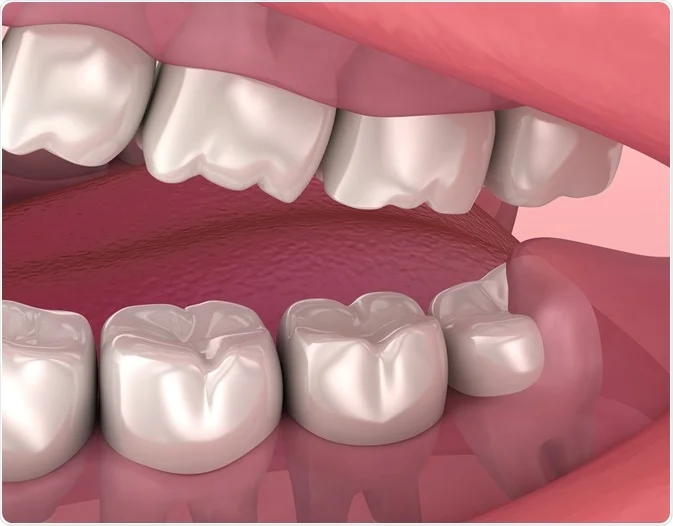 Wisdom Tooth Removal Vancouver