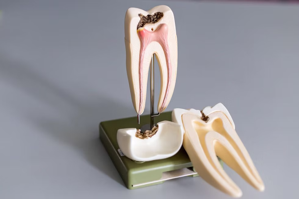 Root Canal Therapy Vancouver