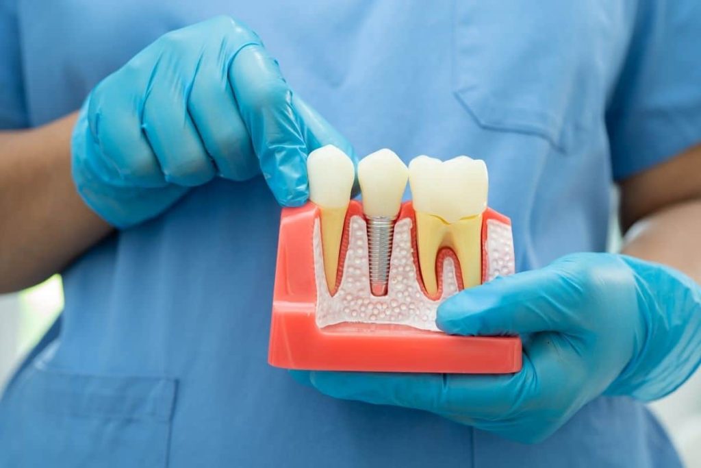 Root canal therapy