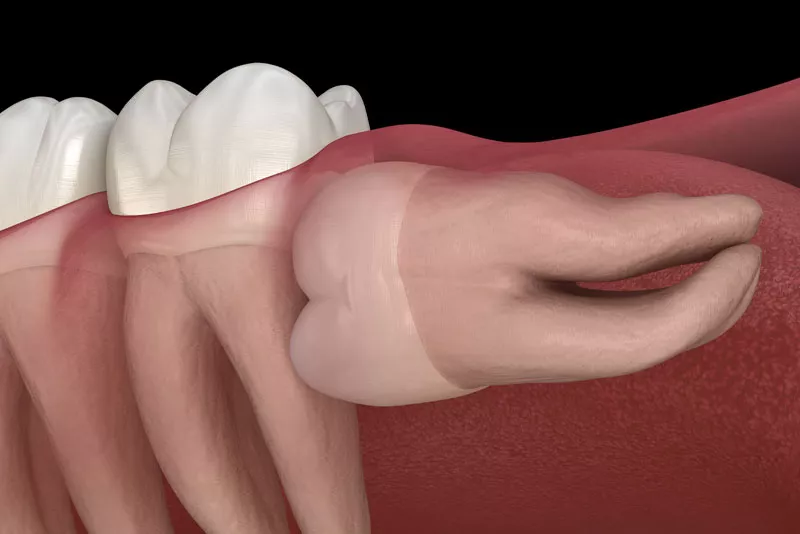 Wisdom Tooth Removal Vancouver