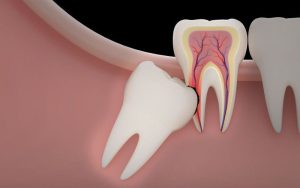Wisdom Tooth Removal Vancouver