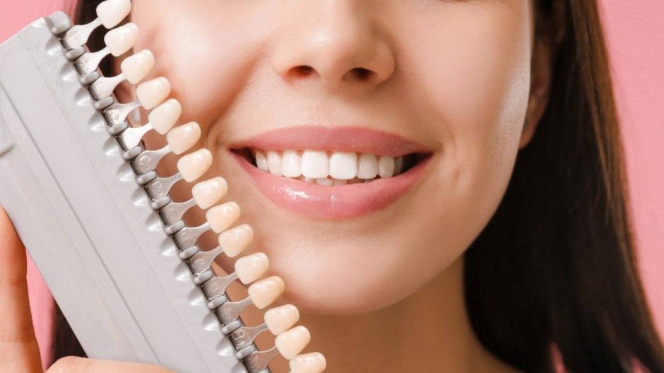 Veneers