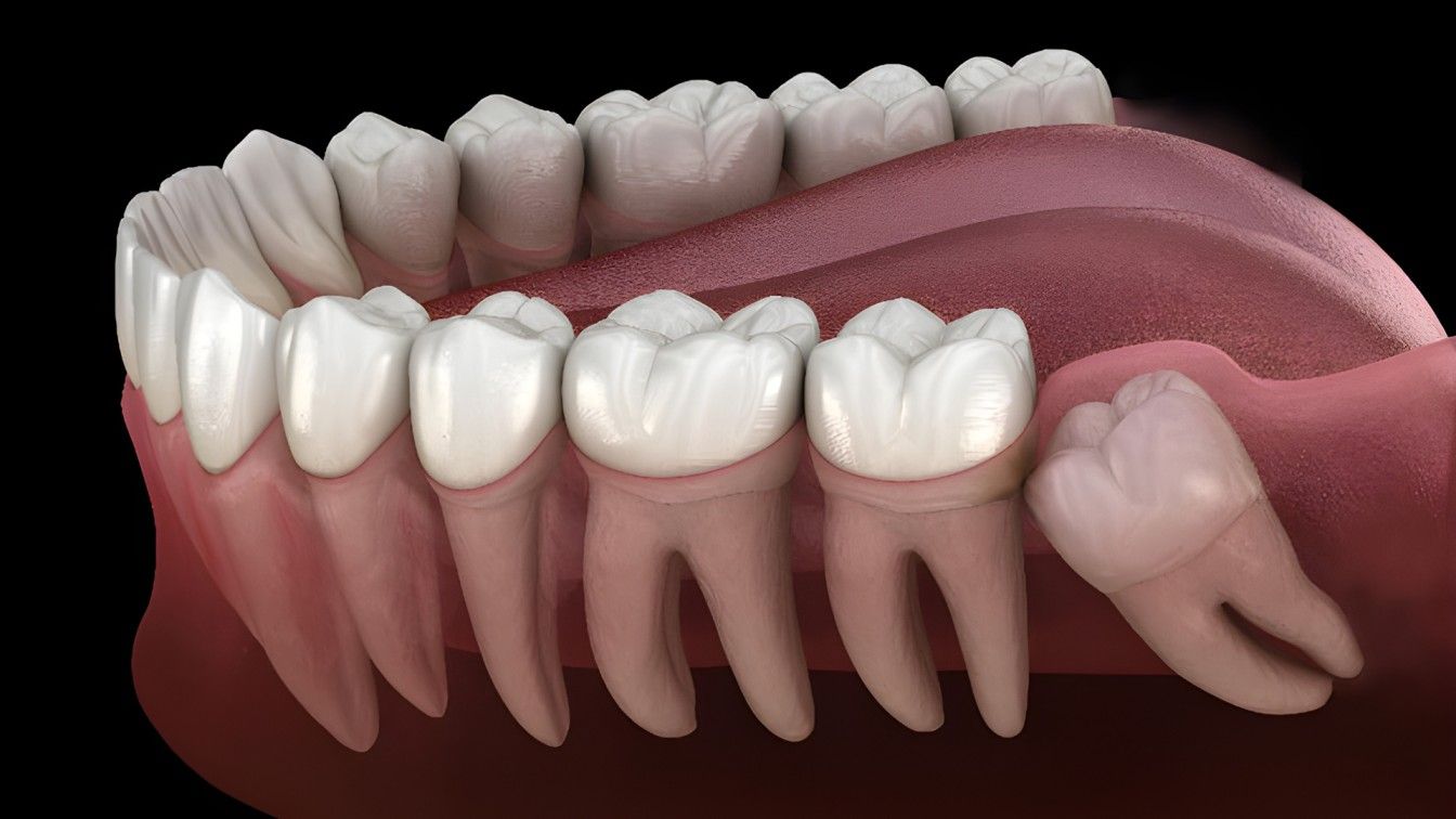 Wisdom Teeth