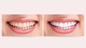 Teeth Whitening