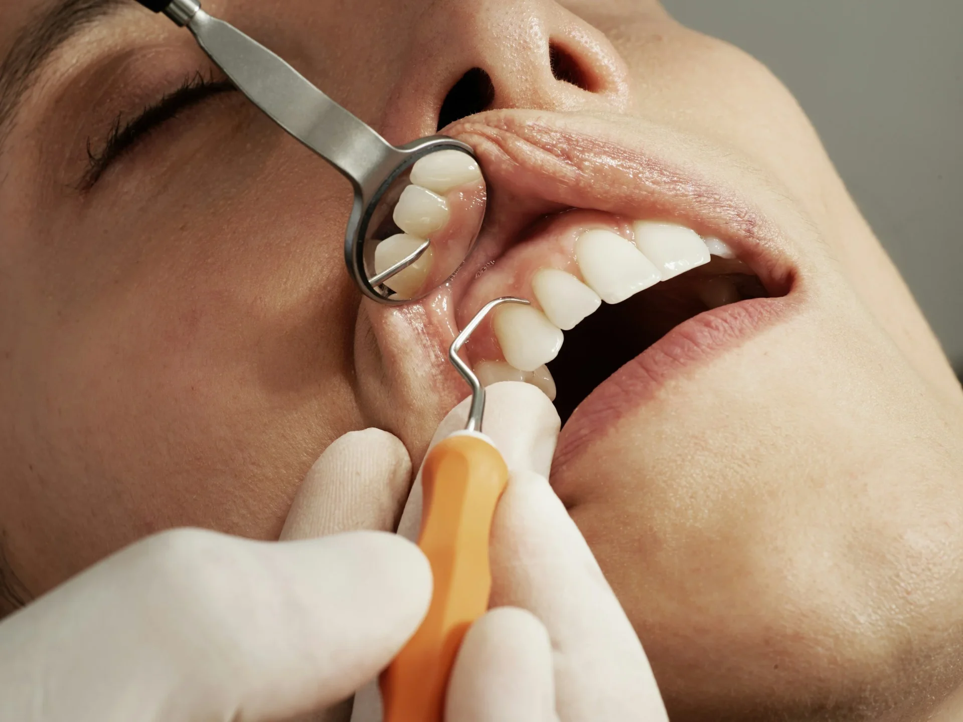 Periodontal scaling procedure close-up