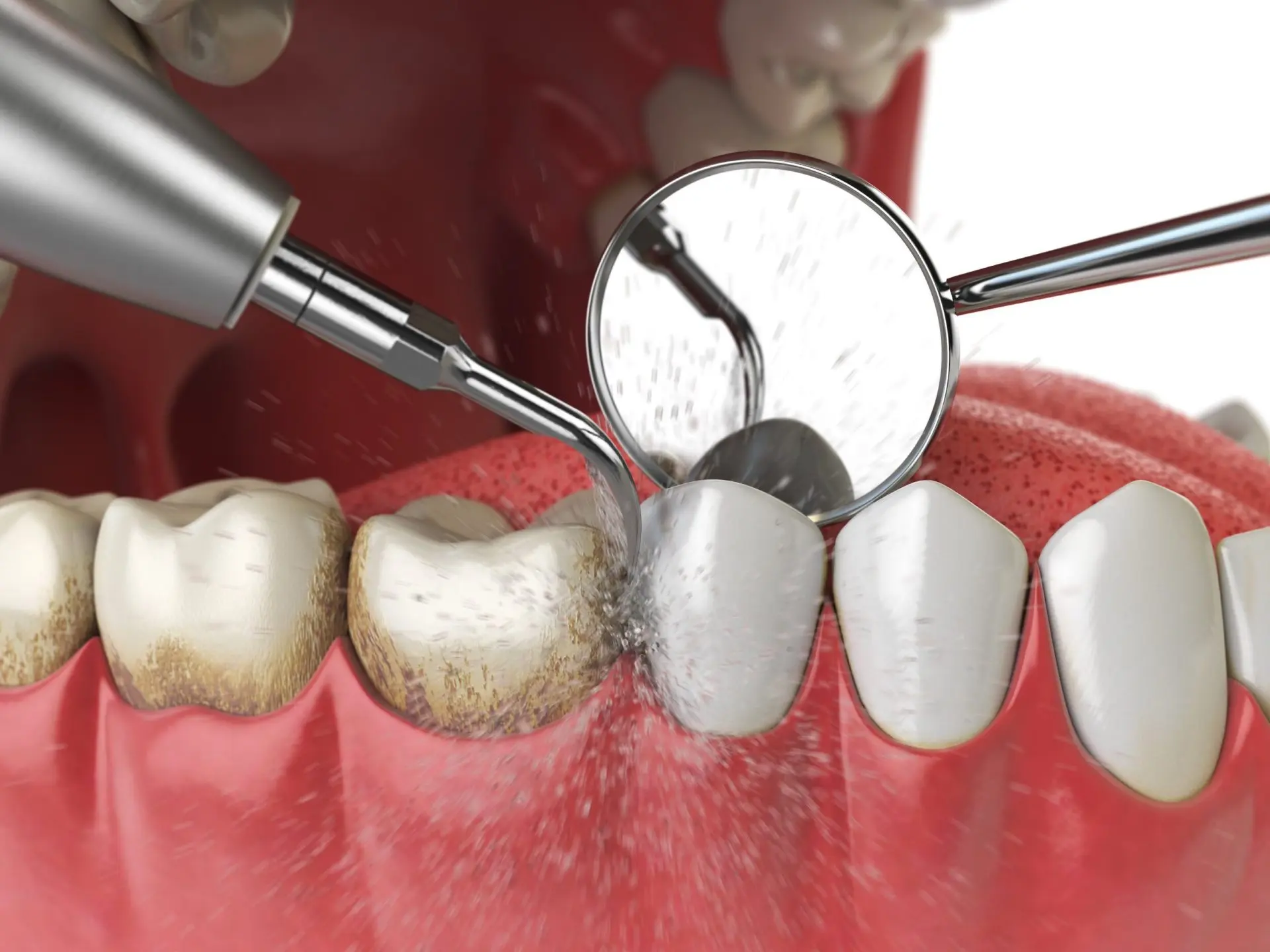 Periodontal maintenance cleaning