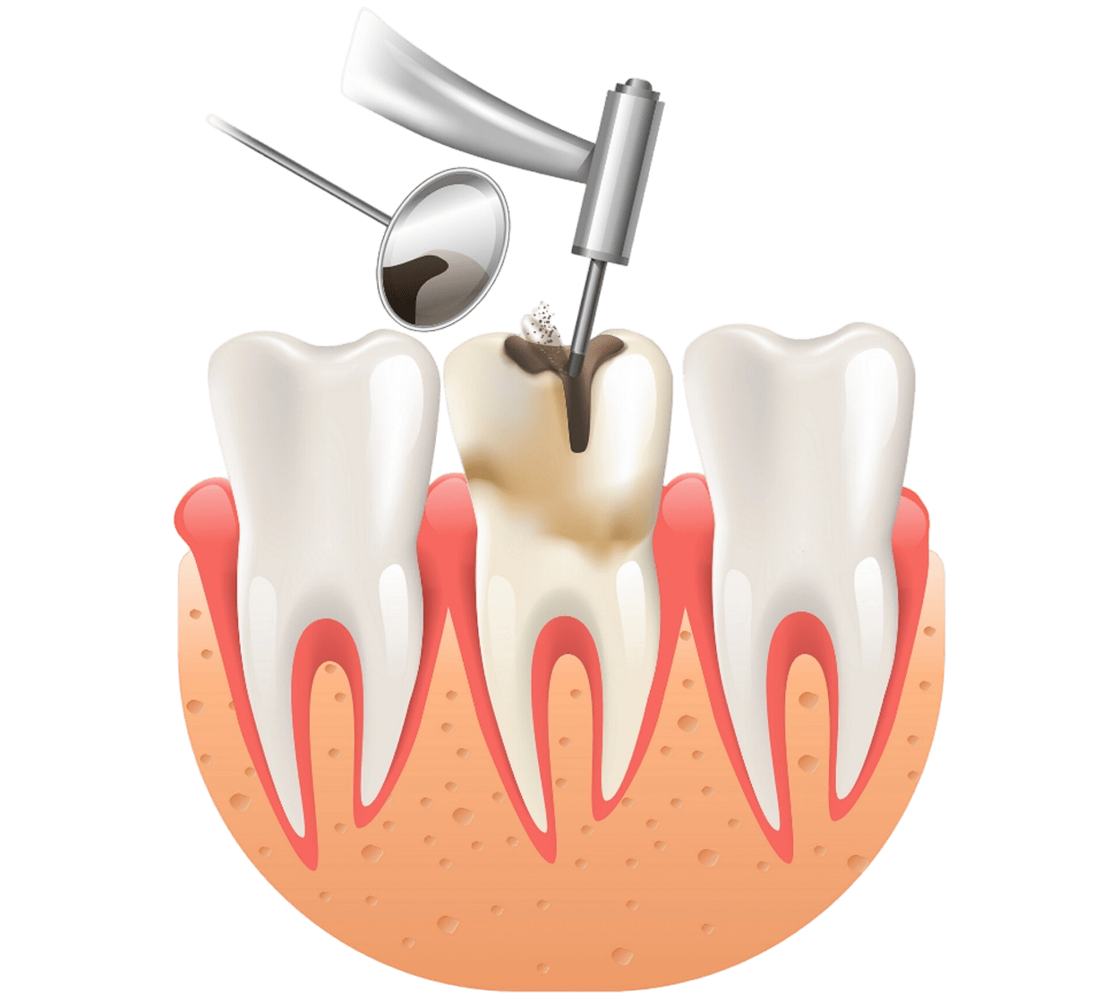 Root canal treatment illustration