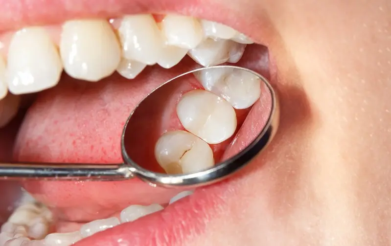 Dental sealants applied to molars